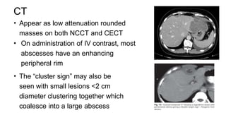 CT
• Appear as low attenuation rounded
masses on both NCCT and CECT
• On administration of IV contrast, most
abscesses have an enhancing
peripheral rim
• The “cluster sign” may also be
seen with small lesions <2 cm
diameter clustering together which
coalesce into a large abscess
 