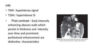 MRI
• TIWI : hypointense signal
• T2WI : hyperintense SI
• Post contrast : Early intensely
enhancing abscess walls which
persist in thickness and intensity
over time and prominent
perilesional enhancement are
distinctive characteristics
 