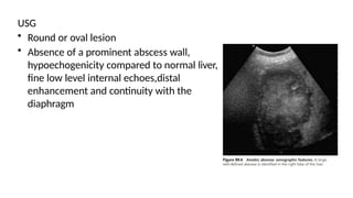 USG
• Round or oval lesion
• Absence of a prominent abscess wall,
hypoechogenicity compared to normal liver,
fine low level internal echoes,distal
enhancement and continuity with the
diaphragm
 
