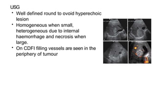 USG
• Well defined round to ovoid hyperechoic
lesion
• Homogeneous when small,
heterogeneous due to internal
haemorrhage and necrosis when
large.
• On CDFI filling vessels are seen in the
periphery of tumour
 