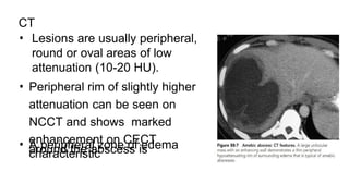 CT
• Lesions are usually peripheral,
round or oval areas of low
attenuation (10-20 HU).
• Peripheral rim of slightly higher
attenuation can be seen on
NCCT and shows marked
enhancement on CECT
• A peripheral zone of edema
around the abscess is
characteristic
 
