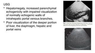 USG
• Hepatomegaly, increased parenchymal
echogenicity with impaired visualization
of normally echogenic walls of
intrahepatic portal venous branches.
• Poor visualization of the deeper portion
of liver, the diaphragm, hepatic and
portal veins
 
