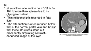 CT
• Normal liver attenuation on NCCT is 8–
10 HU more than spleen due to its
glycogen content.
• This relationship is reversed in fatty
liver.
• The attenuation is often reduced below
that of the normal portal vein and IVC so
that these structures stand out
prominently simulating contrast-
enhanced image of the liver.
 