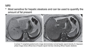 MRI
• Most sensitive for hepatic steatosis and can be used to quantify the
amount of fat present
In-phase T1-weighted gradient-echo image demonstrates normal hepatic signal intensity. B. Opposed-
phase image shows diffuse loss of hepatic signal intensity indicating diffuse hepatic steatosis.
 