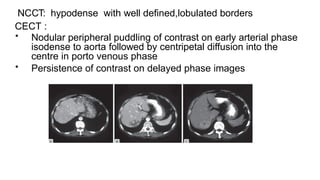NCCT: hypodense with well defined,lobulated borders
CECT :
• Nodular peripheral puddling of contrast on early arterial phase
isodense to aorta followed by centripetal diffusion into the
centre in porto venous phase
• Persistence of contrast on delayed phase images
 