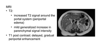 MRI
• T2:
• increased T2 signal around the
portal system (periportal
edema)
• mild generalized increase in
parenchymal signal intensity
• T1 post contrast: delayed, gradual
periportal enhancement
 