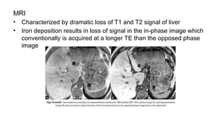 MRI
• Characterized by dramatic loss of T1 and T2 signal of liver
• Iron deposition results in loss of signal in the in-phase image which
conventionally is acquired at a longer TE than the opposed phase
image
 