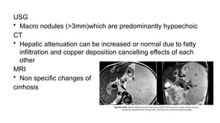 USG
• Macro nodules (>3mm)which are predominantly hypoechoic
CT
• Hepatic attenuation can be increased or normal due to fatty
infiltration and copper deposition cancelling effects of each
other
MRI
• Non specific changes of
cirrhosis
 