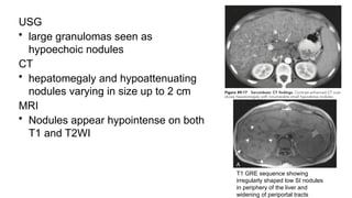 USG
• large granulomas seen as
hypoechoic nodules
CT
• hepatomegaly and hypoattenuating
nodules varying in size up to 2 cm
MRI
• Nodules appear hypointense on both
T1 and T2WI
T1 GRE sequence showing
irregularly shaped low SI nodules
in periphery of the liver and
widening of periportal tracts
 