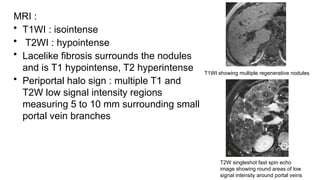 MRI :
• T1WI : isointense
• T2WI : hypointense
• Lacelike fibrosis surrounds the nodules
and is T1 hypointense, T2 hyperintense
• Periportal halo sign : multiple T1 and
T2W low signal intensity regions
measuring 5 to 10 mm surrounding small
portal vein branches
T1WI showing multiple regenerative nodules
T2W singleshot fast spin echo
image showing round areas of low
signal intensity around portal veins
 