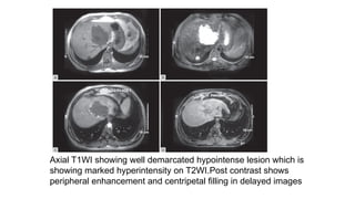 Axial T1WI showing well demarcated hypointense lesion which is
showing marked hyperintensity on T2WI.Post contrast shows
peripheral enhancement and centripetal filling in delayed images
 