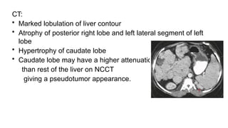 CT:
• Marked lobulation of liver contour
• Atrophy of posterior right lobe and left lateral segment of left
lobe
• Hypertrophy of caudate lobe
• Caudate lobe may have a higher attenuation
than rest of the liver on NCCT
giving a pseudotumor appearance.
 