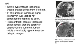 MRI
• T2WI : hyperintense peripheral
wedge-shaped zones from 1 to 5 cm.
• T1WI : areas of increased signal
intensity in liver that do not
correspond to fat may be seen.
• Post contrast : areas of increased
enhancement that are patchy or
segmental are seen that remain
mildly or markedly hyperintense on
delayed images.
Axial T2WfsatI showing lobulated
liver with caudate hypertrophy and
atrophy of left lateral lobe
T1pc showing peripheral areas of
fibrosis with contrast in delayed
film
 