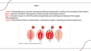 Infundibulation Types benign & malignant lesions of vulva copy copy.pptx