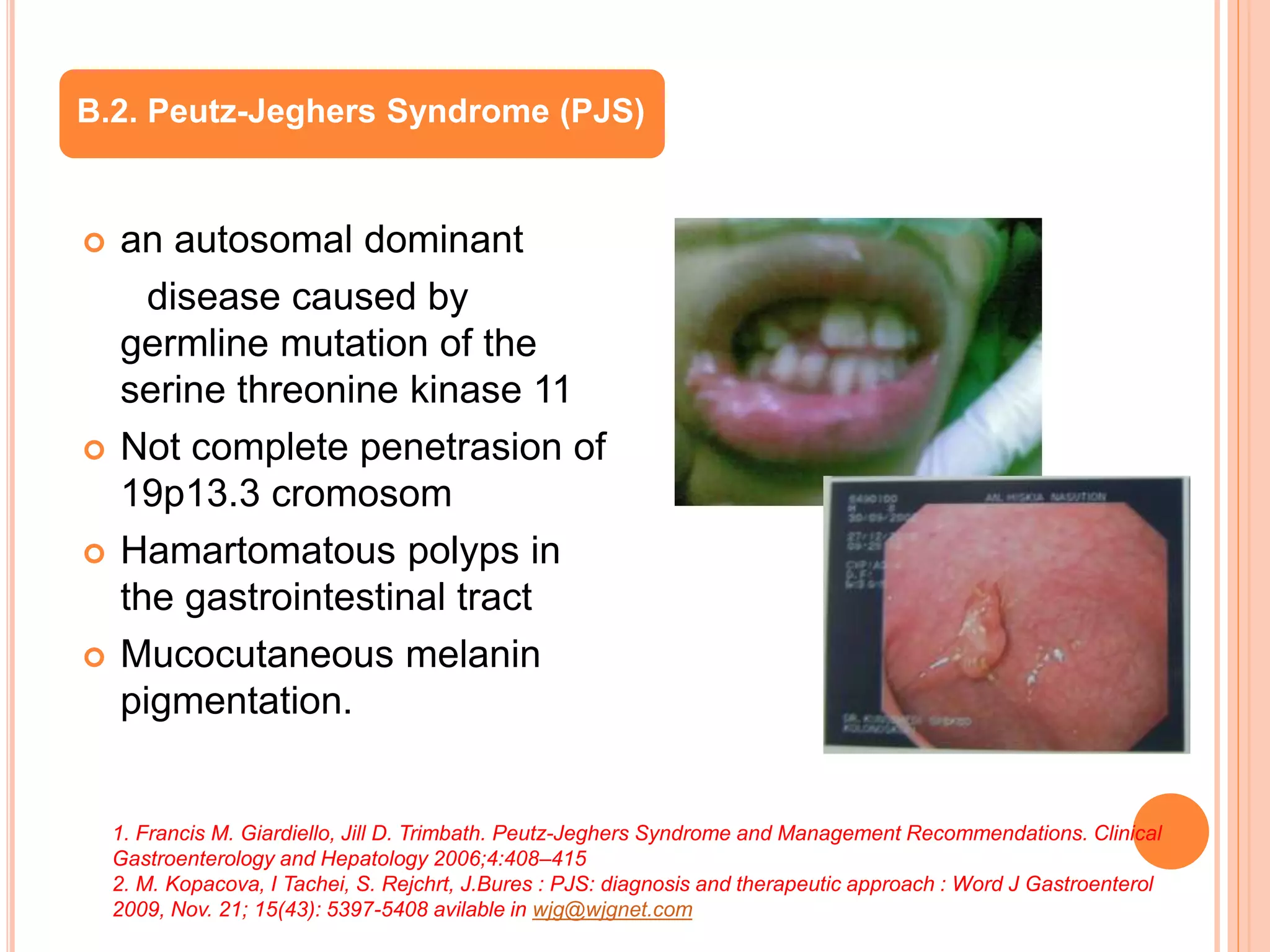  an autosomal dominant
disease caused by
germline mutation of the
serine threonine kinase 11
 Not complete penetrasion of
19p13.3 cromosom
 Hamartomatous polyps in
the gastrointestinal tract
 Mucocutaneous melanin
pigmentation.
B.2. Peutz-Jeghers Syndrome (PJS)
1. Francis M. Giardiello, Jill D. Trimbath. Peutz-Jeghers Syndrome and Management Recommendations. Clinical
Gastroenterology and Hepatology 2006;4:408–415
2. M. Kopacova, I Tachei, S. Rejchrt, J.Bures : PJS: diagnosis and therapeutic approach : Word J Gastroenterol
2009, Nov. 21; 15(43): 5397-5408 avilable in wjg@wjgnet.com
 