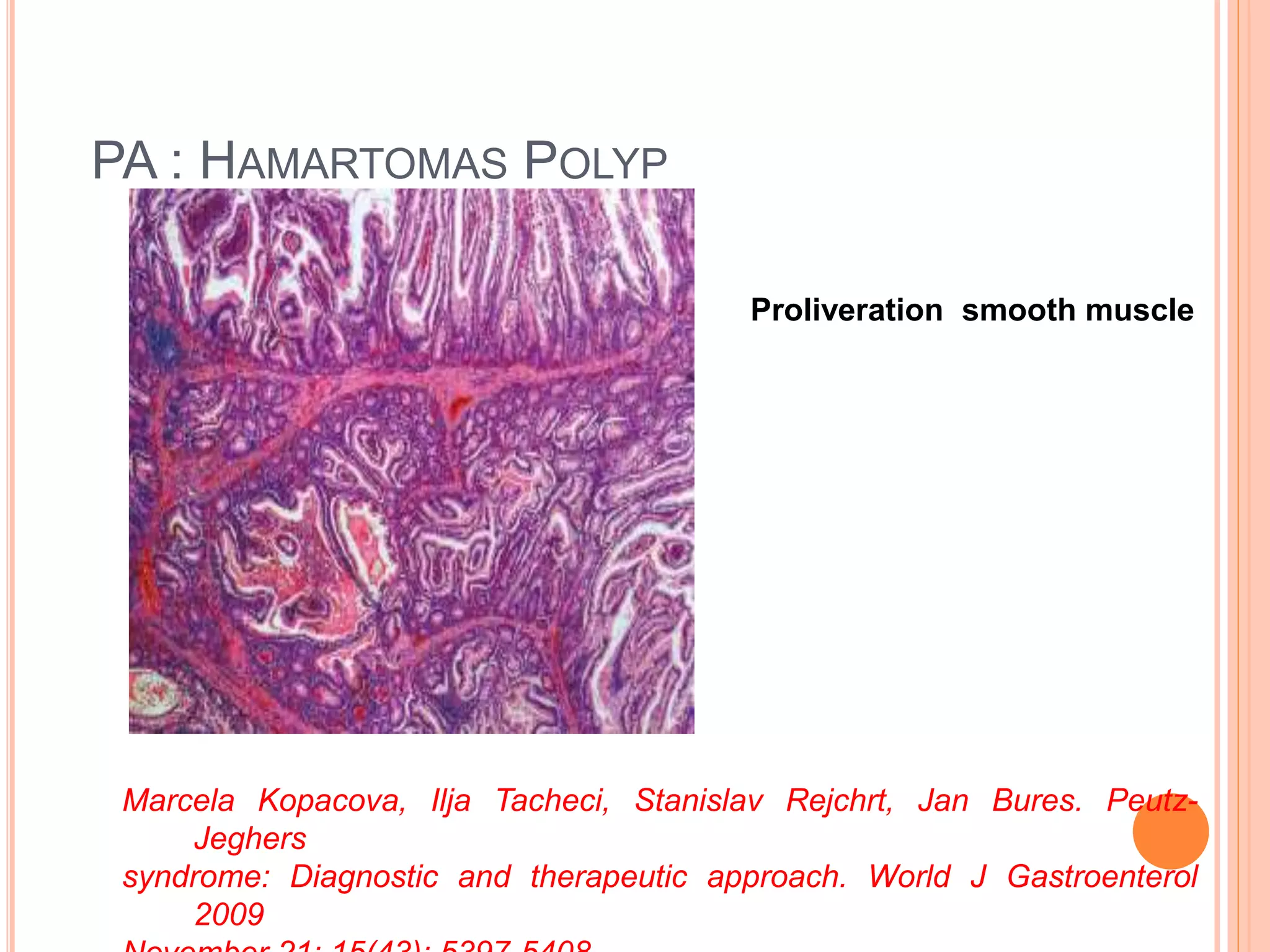 PA : HAMARTOMAS POLYP
Proliveration smooth muscle
Marcela Kopacova, Ilja Tacheci, Stanislav Rejchrt, Jan Bures. Peutz-
Jeghers
syndrome: Diagnostic and therapeutic approach. World J Gastroenterol
2009
 