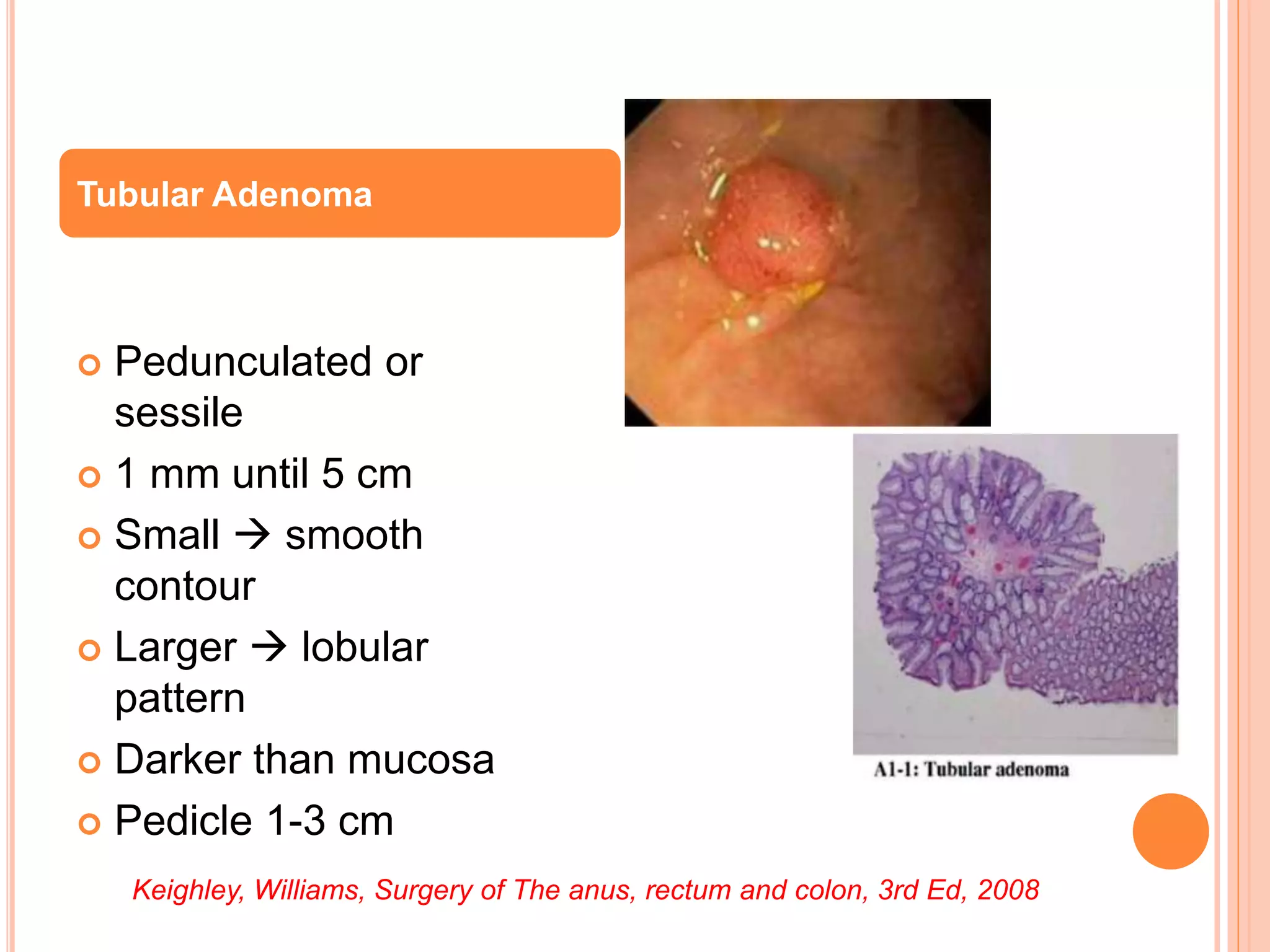  Pedunculated or
sessile
 1 mm until 5 cm
 Small  smooth
contour
 Larger  lobular
pattern
 Darker than mucosa
 Pedicle 1-3 cm
Tubular Adenoma
Keighley, Williams, Surgery of The anus, rectum and colon, 3rd Ed, 2008
 