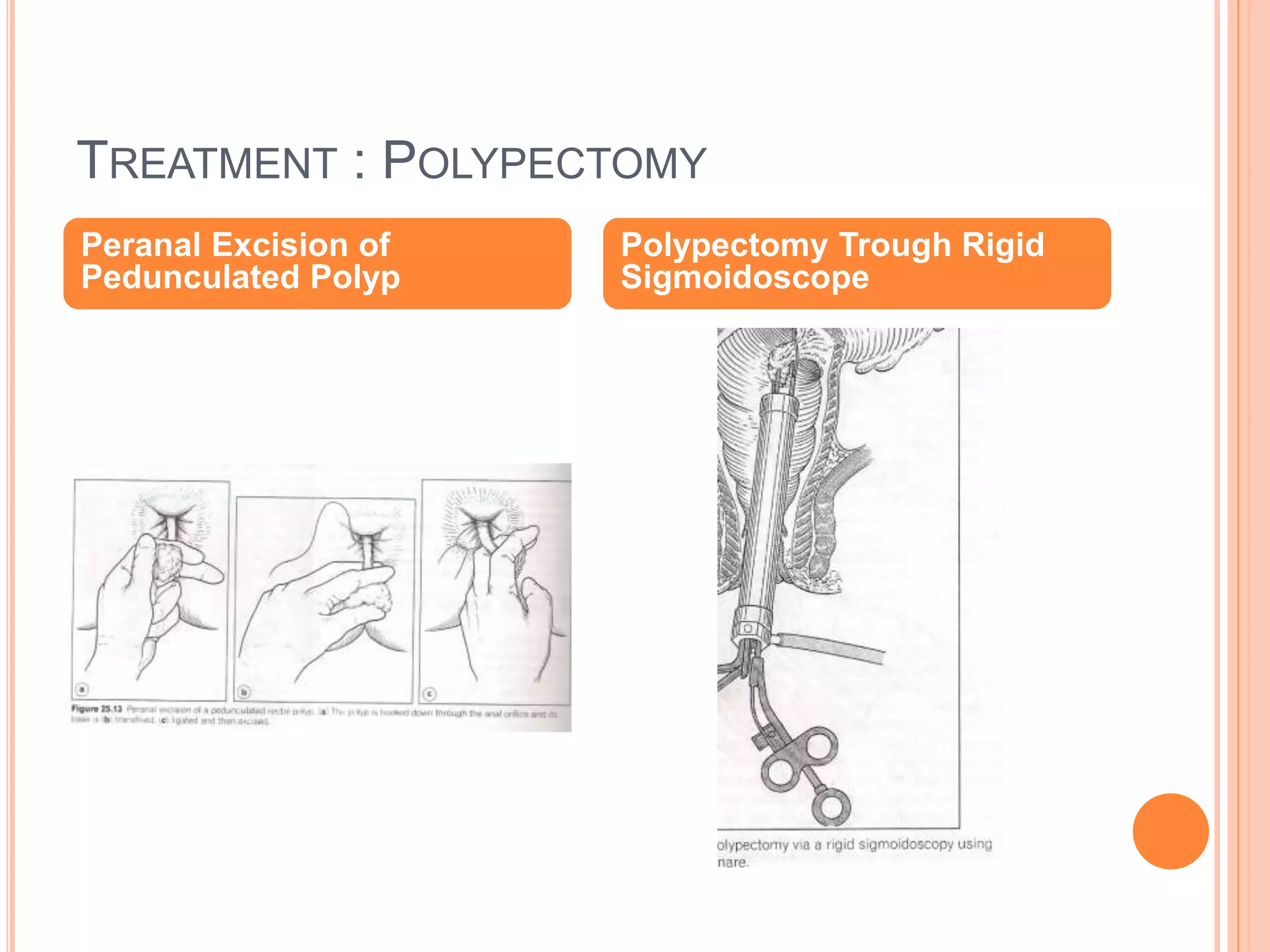 TREATMENT : POLYPECTOMY
Peranal Excision of
Pedunculated Polyp
Polypectomy Trough Rigid
Sigmoidoscope
 