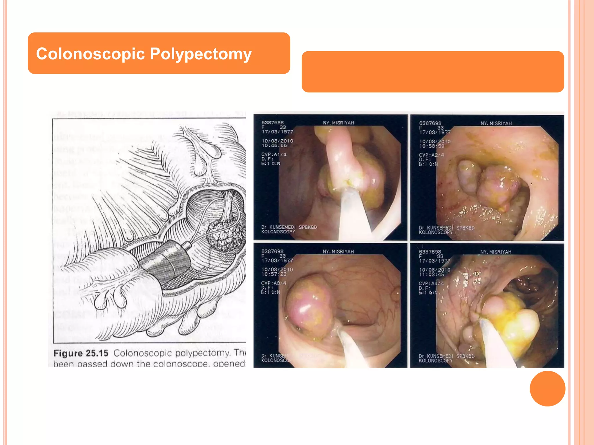 Colonoscopic Polypectomy
 