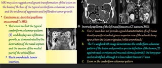 BENIGN NEOPLASMS OF THE NOSE AND PNS.pptx