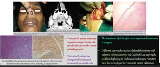 BENIGN NEOPLASMS OF THE NOSE AND PNS.pptx