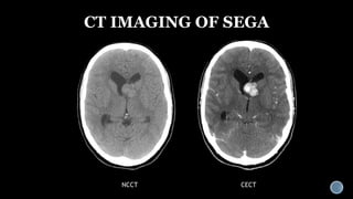 Benign neoplastic lesions of brain | PPTX