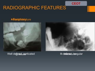 Benign odontogenic tumors 1 | PPTX