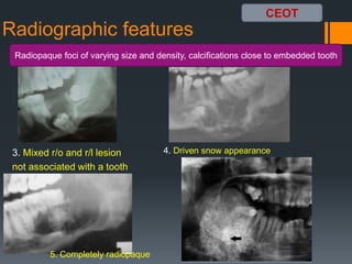 Benign odontogenic tumors 1 | PPTX