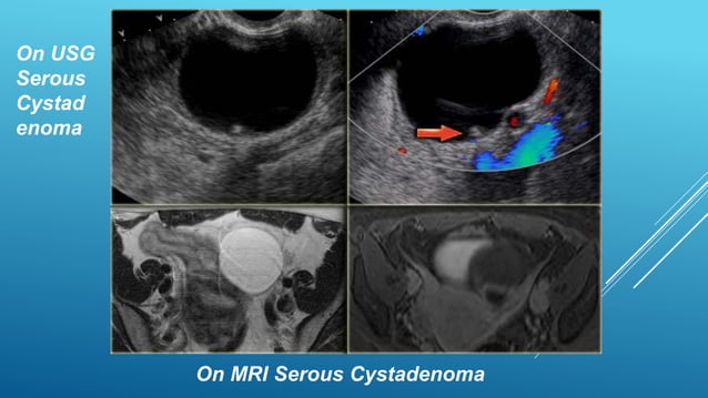 Benign Ovarian Tumours Benign Ovarian Tumours