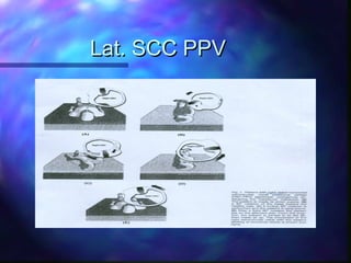 Lat. SCC PPV
 