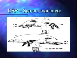 CRP – Semont maneuver
 