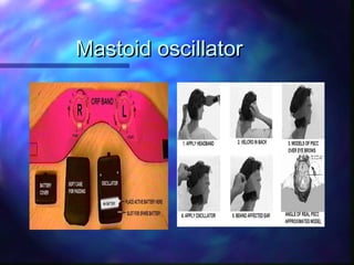 Mastoid oscillator
 