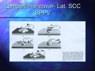 Lampert maneuver- Lat. SCC
          BPPV
 