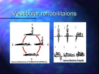 Vestibular rehabilitaions
 