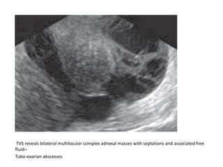 Benign pelvic diseases in females 2 | PPTX