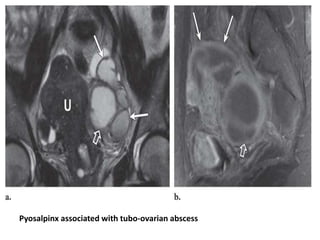 Benign pelvic diseases in females 2 | PPTX