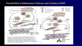 Potential Role of Inflammatory Pathways and Cytokines in BPH
 