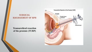 SURGICAL
MANAGEMENT OF BPH
Transurethral resection
of the prostate (TURP)
 