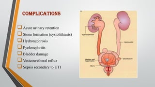 COMPLICATIONS
Acute urinary retention
Stone formation (cystolithiasis)
Hydronephrosis
Pyelonephritis
Bladder damage
Vesicouretheral reflux
Sepsis secondary to UTI
 