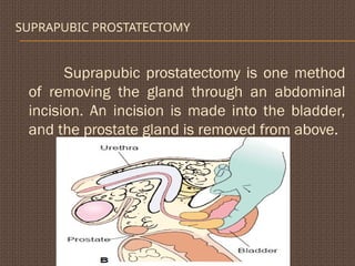 SUPRAPUBIC PROSTATECTOMY
Suprapubic prostatectomy is one method
of removing the gland through an abdominal
incision. An incision is made into the bladder,
and the prostate gland is removed from above.
 