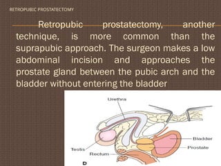 RETROPUBIC PROSTATECTOMY
Retropubic prostatectomy, another
technique, is more common than the
suprapubic approach. The surgeon makes a low
abdominal incision and approaches the
prostate gland between the pubic arch and the
bladder without entering the bladder
 