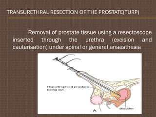 TRANSURETHRAL RESECTION OF THE PROSTATE(TURP)
Removal of prostate tissue using a resectoscope
inserted through the urethra (excision and
cauterisation) under spinal or general anaesthesia
 