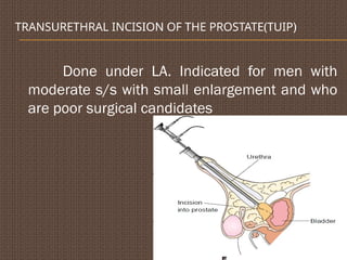 TRANSURETHRAL INCISION OF THE PROSTATE(TUIP)
Done under LA. Indicated for men with
moderate s/s with small enlargement and who
are poor surgical candidates
 