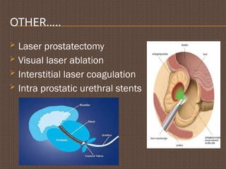 OTHER…..
 Laser prostatectomy
 Visual laser ablation
 Interstitial laser coagulation
 Intra prostatic urethral stents
 