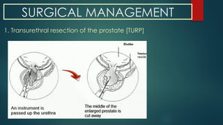 SURGICAL MANAGEMENT
1. Transurethral resection of the prostate [TURP]
 