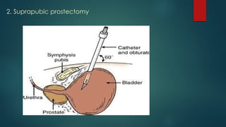 2. Suprapubic prostectomy
 