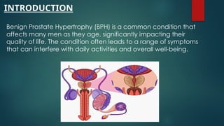 INTRODUCTION
Benign Prostate Hypertrophy (BPH) is a common condition that
affects many men as they age, significantly impacting their
quality of life. The condition often leads to a range of symptoms
that can interfere with daily activities and overall well-being.
 