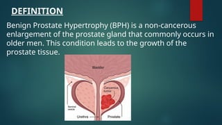 DEFINITION
Benign Prostate Hypertrophy (BPH) is a non-cancerous
enlargement of the prostate gland that commonly occurs in
older men. This condition leads to the growth of the
prostate tissue.
 