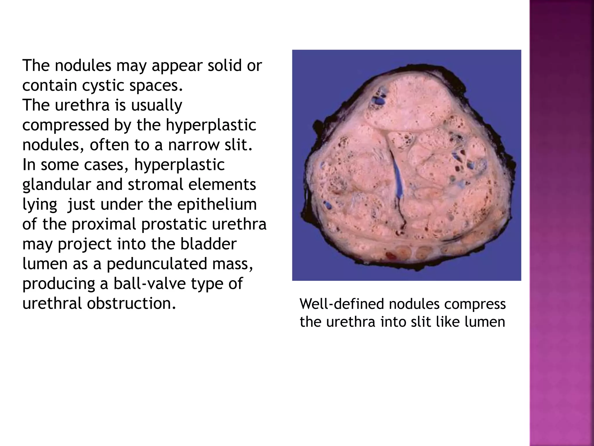 The nodules may appear solid or
contain cystic spaces.
The urethra is usually
compressed by the hyperplastic
nodules, often to a narrow slit.
In some cases, hyperplastic
glandular and stromal elements
lying just under the epithelium
of the proximal prostatic urethra
may project into the bladder
lumen as a pedunculated mass,
producing a ball-valve type of
urethral obstruction. Well-defined nodules compress
the urethra into slit like lumen
 