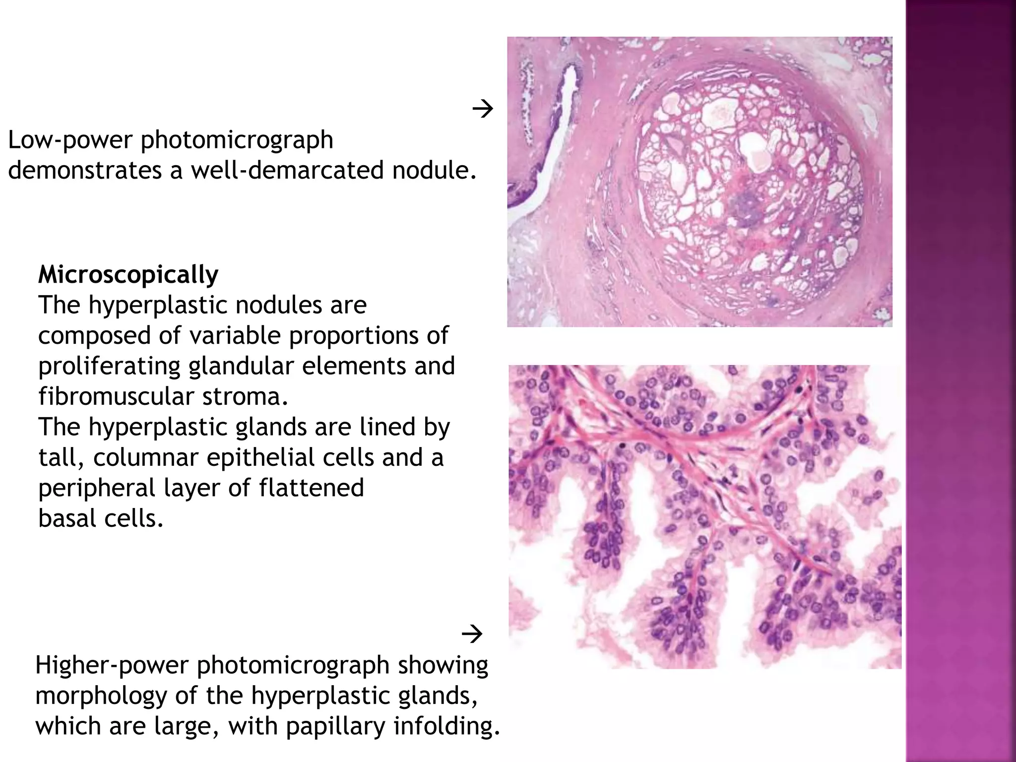 Microscopically
The hyperplastic nodules are
composed of variable proportions of
proliferating glandular elements and
fibromuscular stroma.
The hyperplastic glands are lined by
tall, columnar epithelial cells and a
peripheral layer of flattened
basal cells.

Low-power photomicrograph
demonstrates a well-demarcated nodule.

Higher-power photomicrograph showing
morphology of the hyperplastic glands,
which are large, with papillary infolding.
 